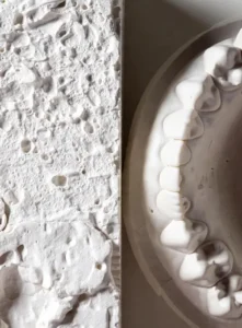 انواع گچ دندان پزشکی